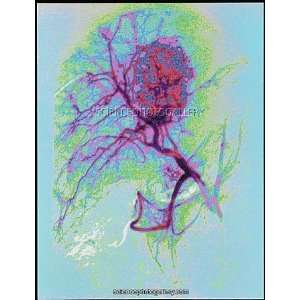  Coloured angiogram X ray of a tumour in the liver Framed 